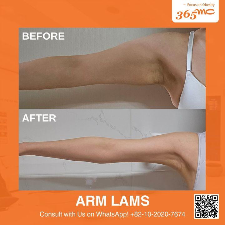 cost lams korea
