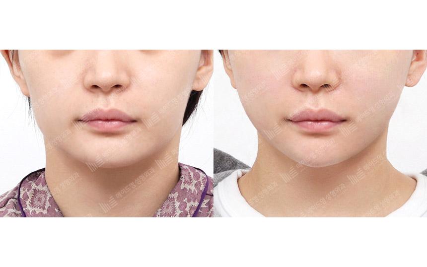 Before and After Face Lift