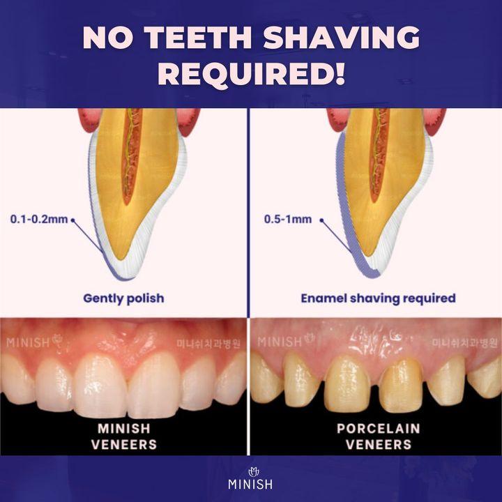 Veneers, All-ceramic Veneers