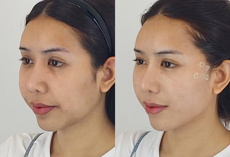 Female mini thread lift 10thera