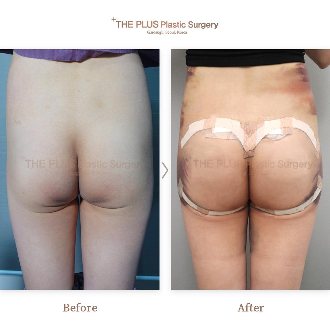 THEPLUS Plastic Surgery before and after image