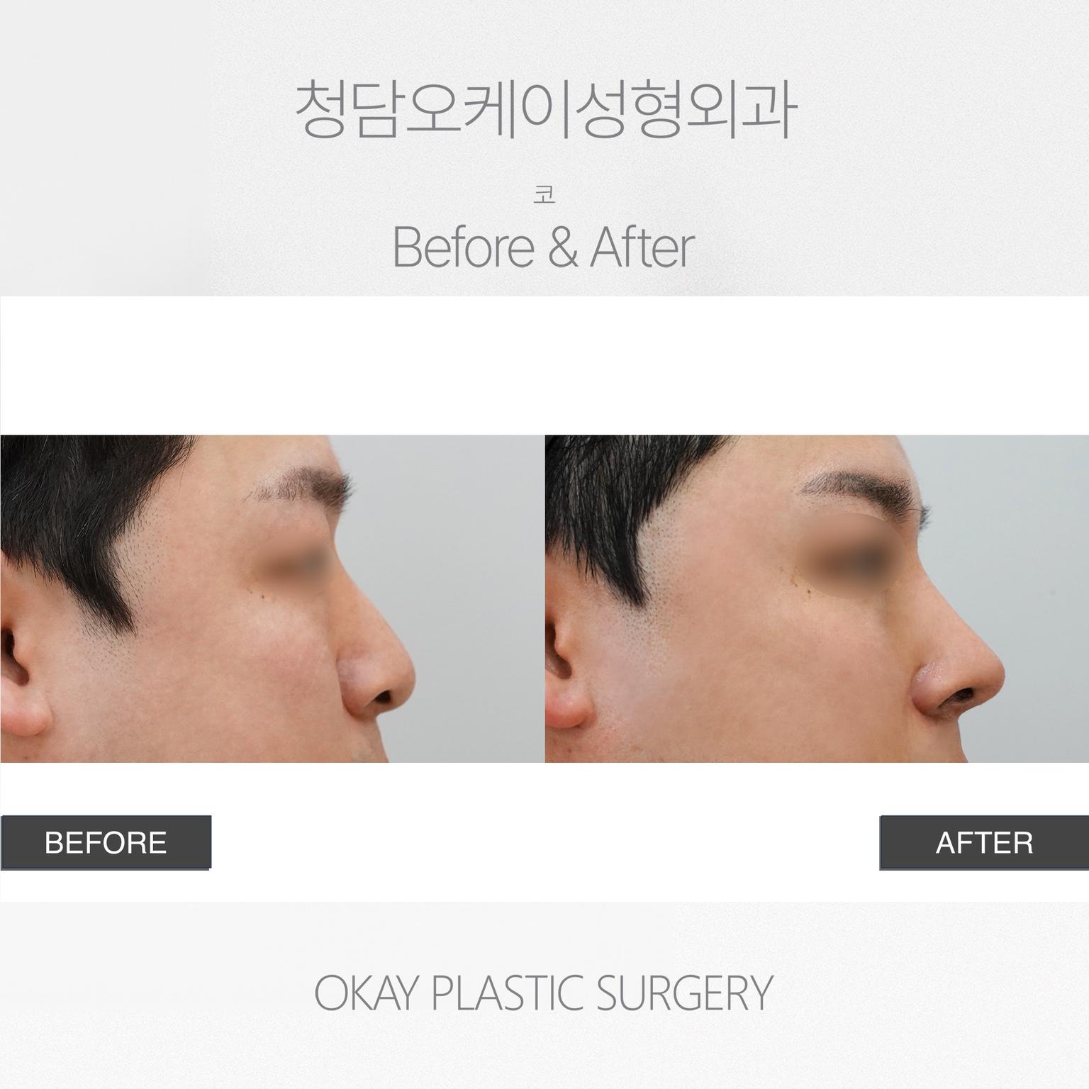 Okay Plastic Surgery Clinic before and after image