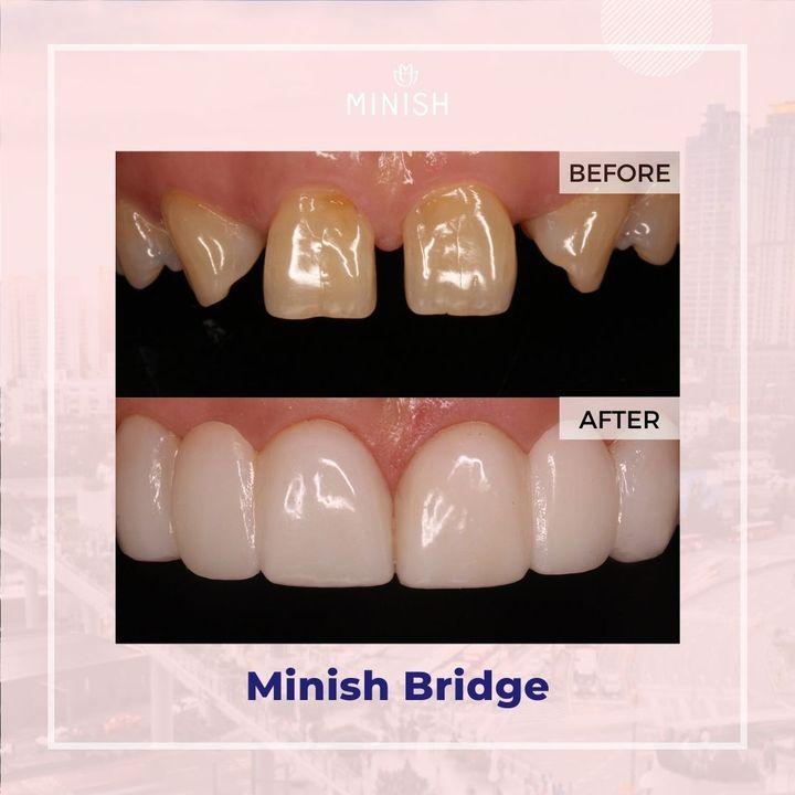 Revolutionize Your Smile with Veneers: Unveil Radiance and Confidence! Say hello to a dazzling smile transformation with our premium MINISH veneer solutions~