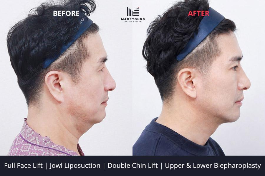 Face lift jowl liposuction double chin lift upper blepharoplasty upper eyelid fat grafting lower blepharoplasty