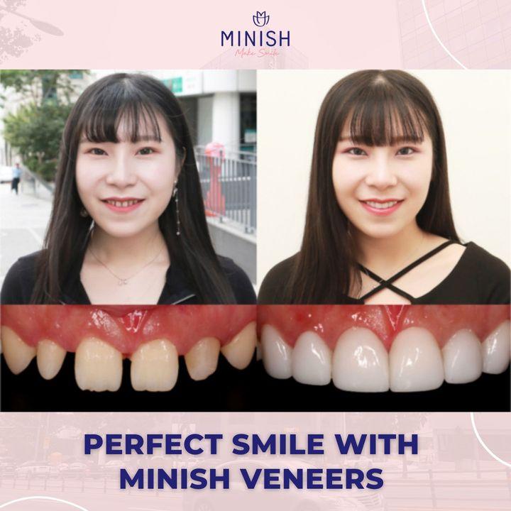 Witness the beauty transformation with Minish veneers in our latest before and after showcase.