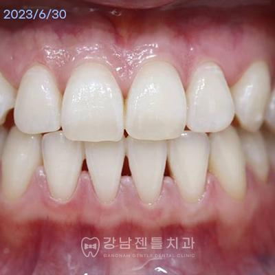 After Teeth Whitening