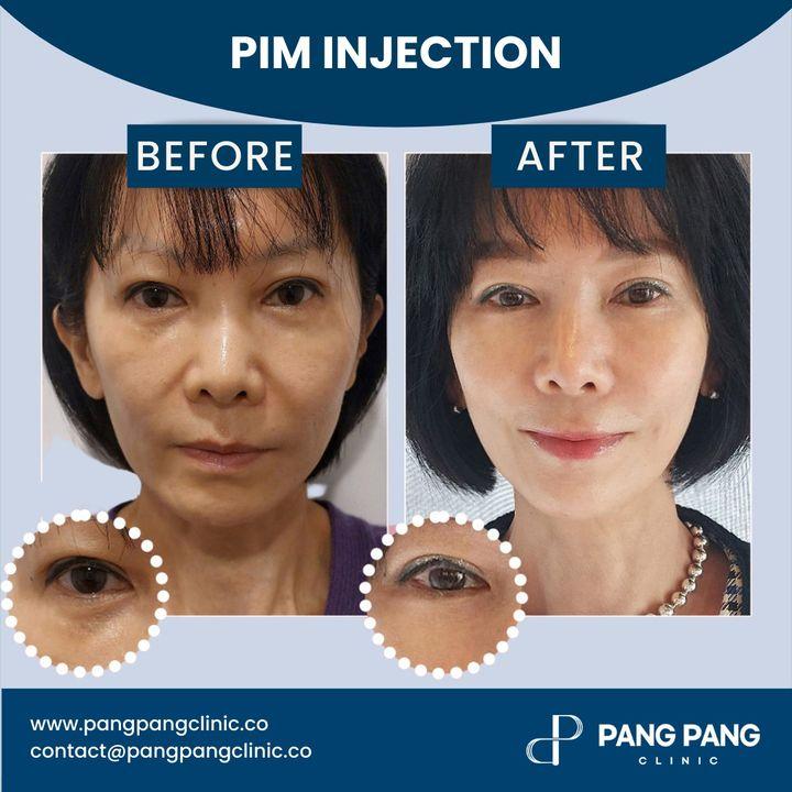 Discover the Magic of PIM Injection at PangPang Clinic!   Achieve volume and smooth skin in just 30 minutes!  Our non-invasive PIM Injections use advanced collagen stimulator for a natural, firmer look.  Book now for a radiant transformation!