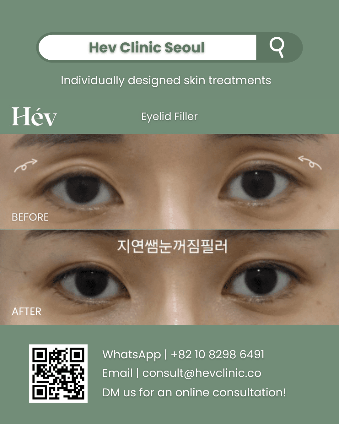 Eyelid Filler