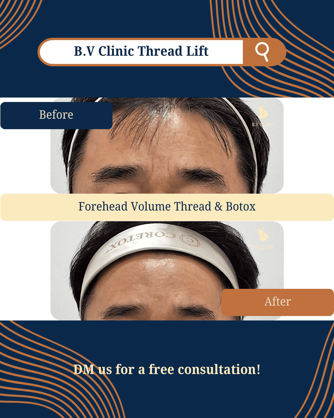Stirn-Fadenlifting, Stirn-Botox