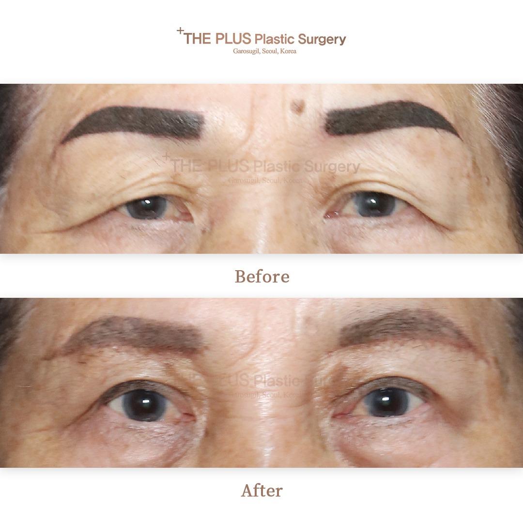 Double eyelid surgery (partial incision)