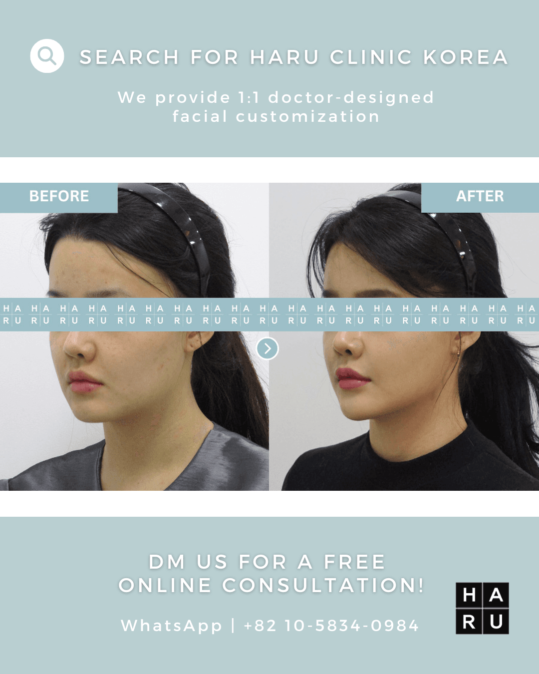 Chin Filler, Chin Botox, Fat Dissolving Injection