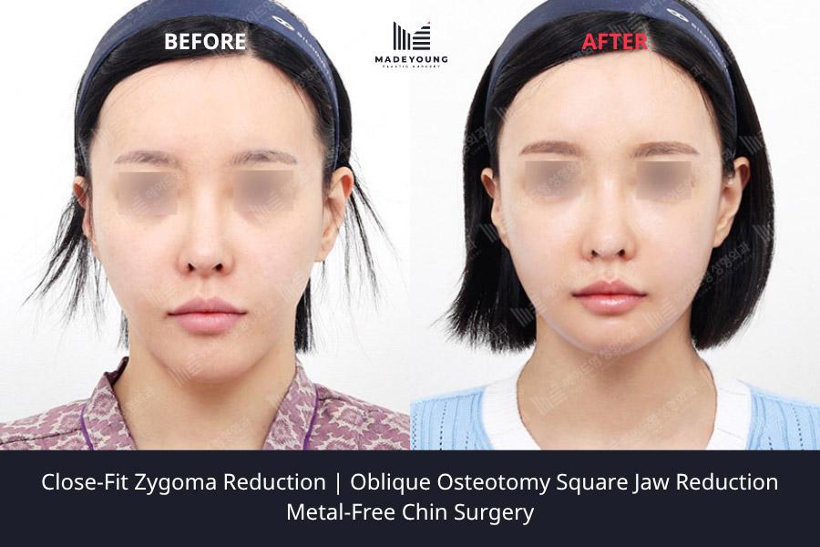 Fit zygoma reduction oblique osteotomy square jaw reduction metal free chin surgery 1