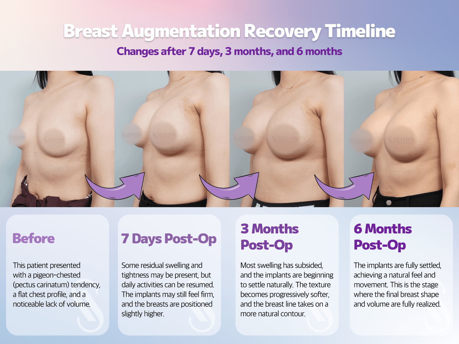 Breast Augmentation, Breast Surgery