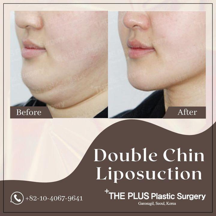 Define your jawline and enhance your profile with our double-chin liposuction. The before and after pictures reveal the impact of targeted contouring for a more defined, youthful appearance. Let's sculpt your confidence together. #ChinContouring #sleekprofile   ►