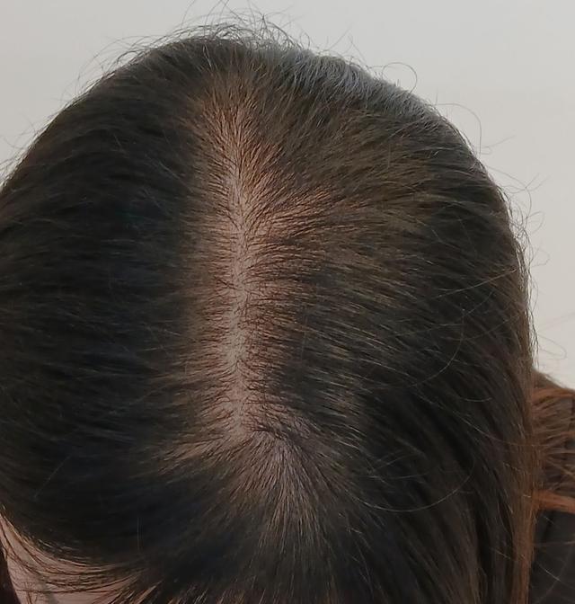 After Hair Loss Treatment