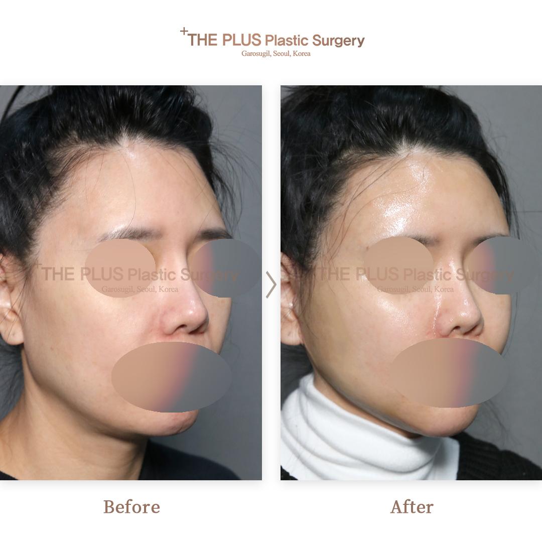 Face contouring + Mini Face Lifting + Thread Lifting + Double Chin Tightening