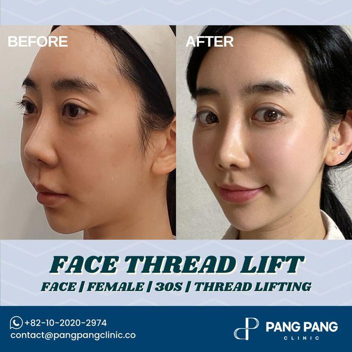 Experience the transformative power of a face thread lift. Our before and after photos tell the story of rejuvenation.