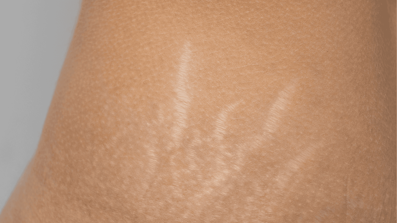 Stretch Mark Treatment
