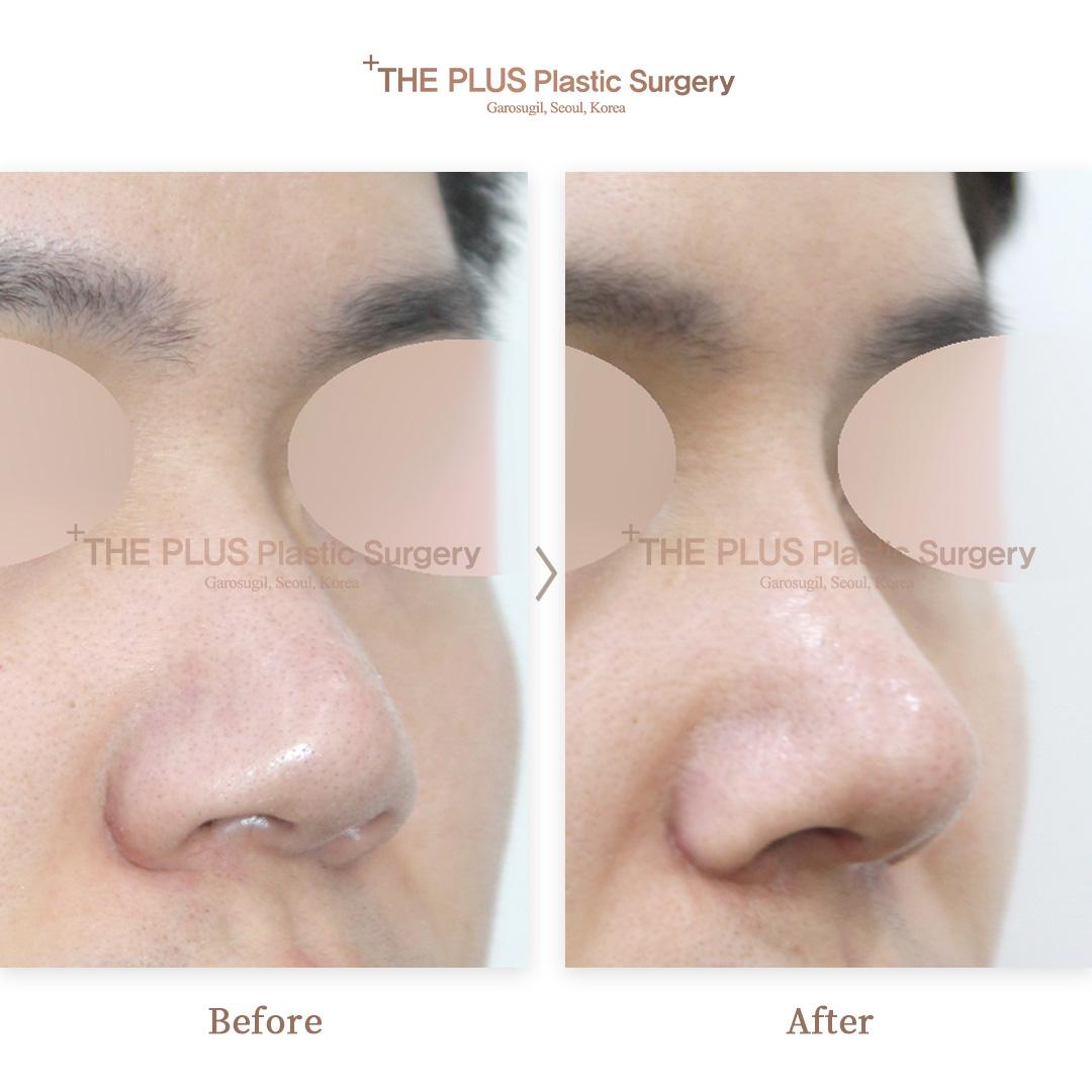 Primary Rhinoplasty & Alar Reduction & Nostril Retraction Correction & Ear Cartilage & Nose Osteotomy