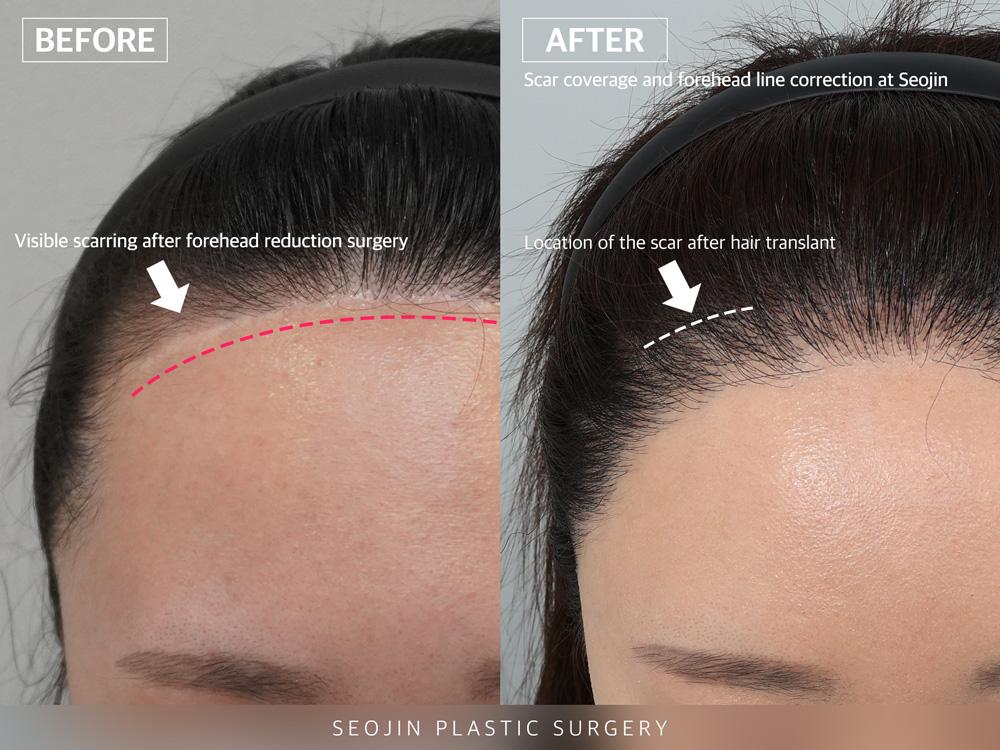 Haartransplantation auf Narben und Korrektur der Stirnhaarlinie bei Seojin