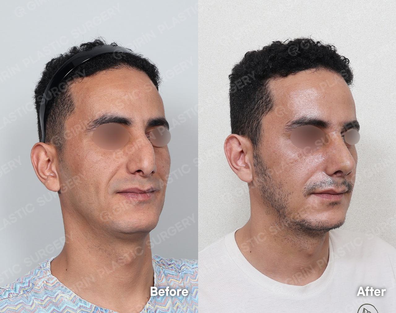 Before and After Rhinoplasty