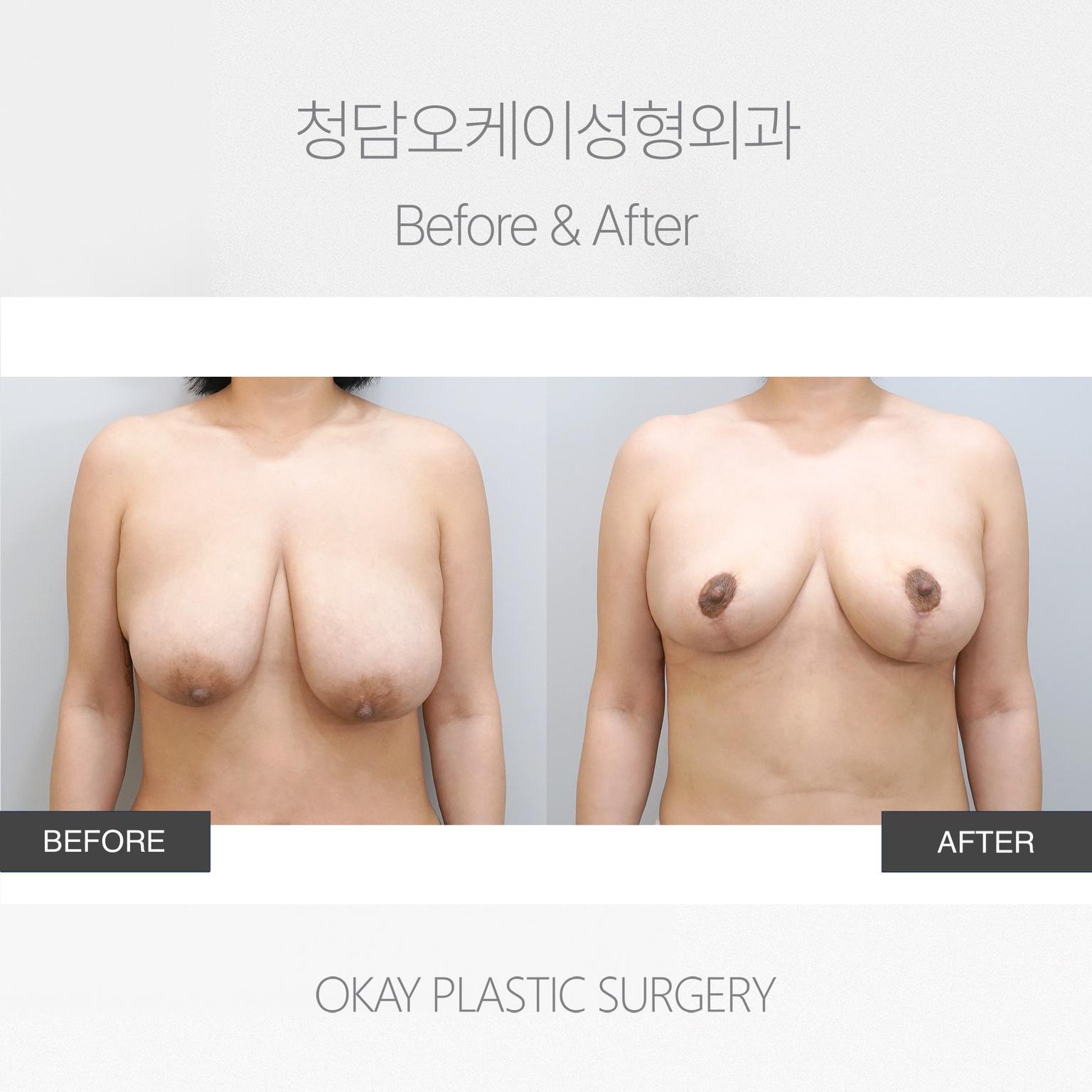 Breast Lift with Areolar Incision Method