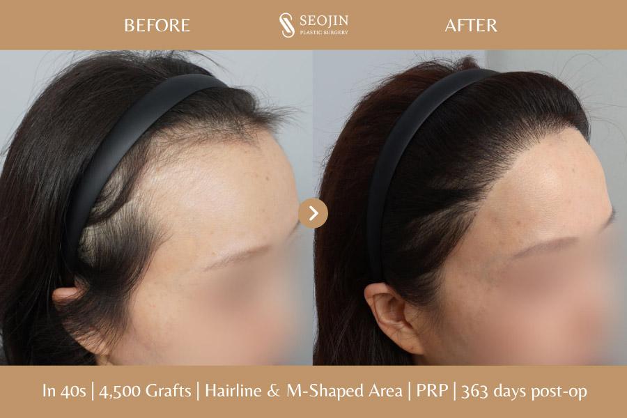 Before and After Hair Transplant