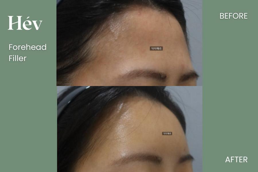 Forehead Filler