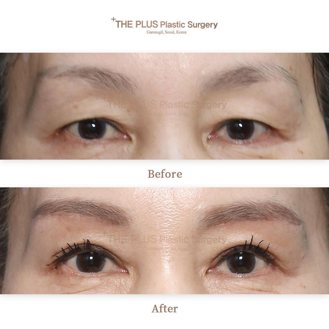 Double eyelid surgery (non-incision)