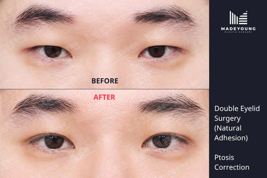 Eyelid surgery natural adhesion ptosis correction