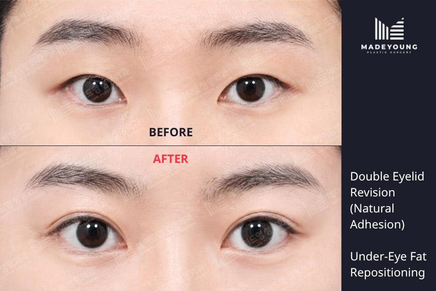 Before and After Revision Eye Surgery