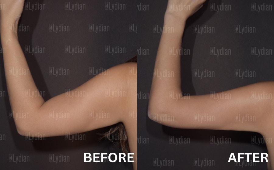 Lydian Plastic Surgery Clinic before and after image