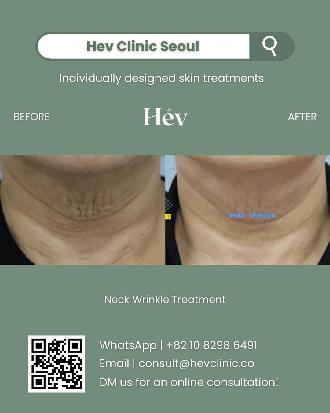 Neck Wrinkle Treatment