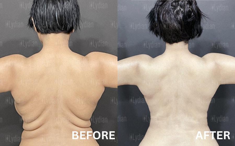 mid back fat korea