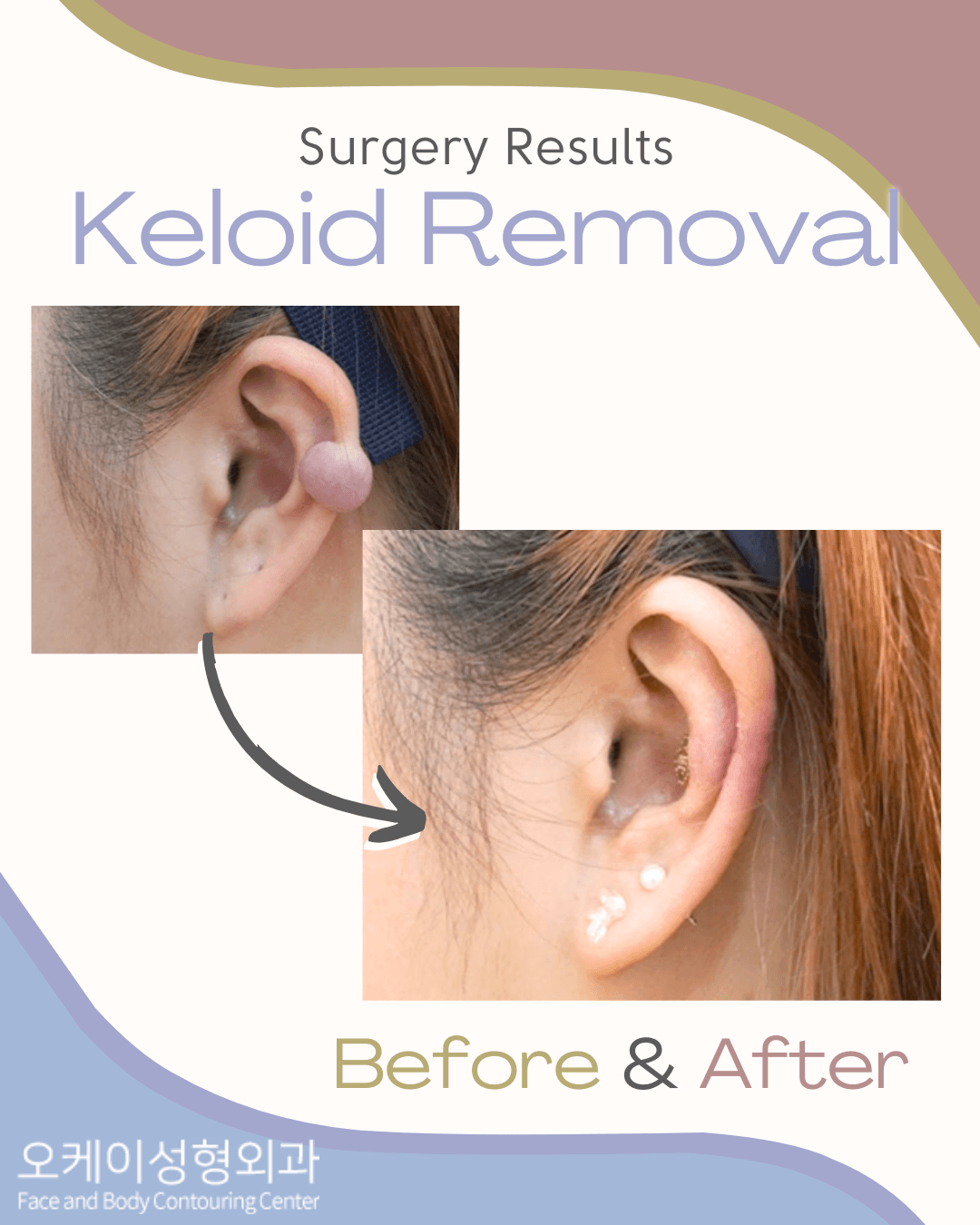 Okay Plastic Surgery Clinic before and after image