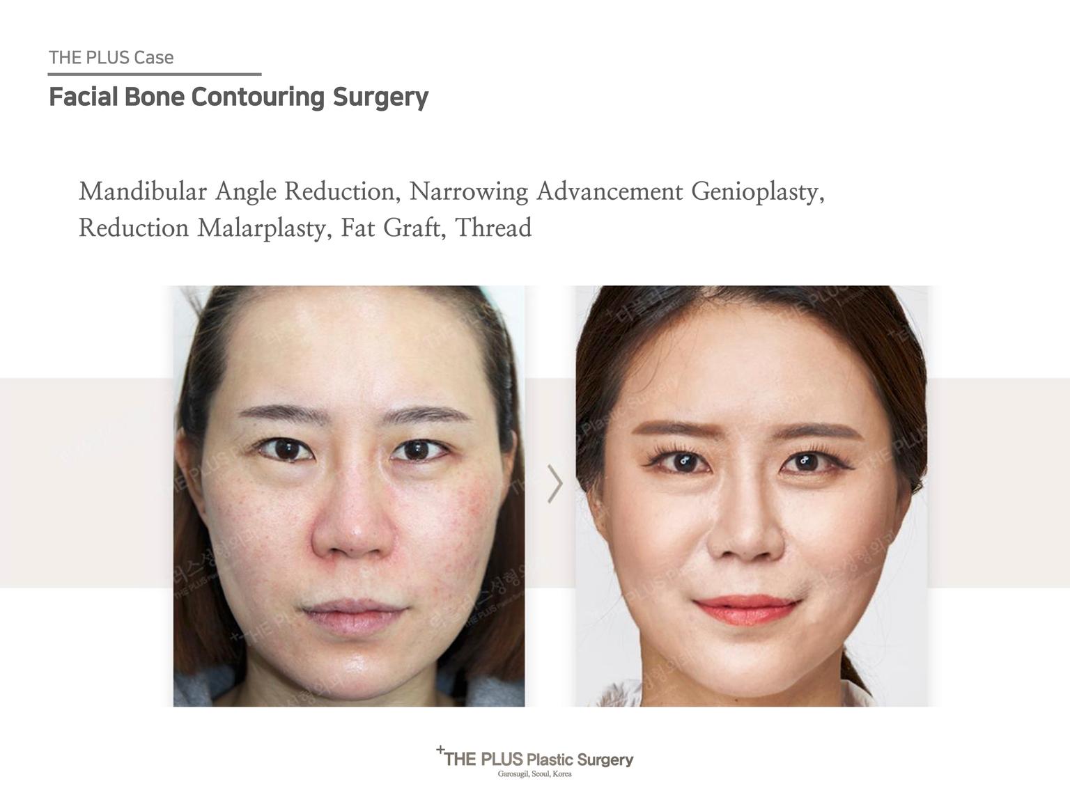 Mandibular Angle Reduction & Narrowing Advancement Genioplasty & Reduction Malarplasty & Fat Graft