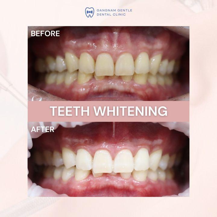Glimpse the effectiveness of our teeth whitening procedure. Our patients leave with smiles that are both healthier and whiter.