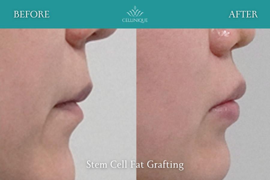 Before and After Stem Cell Fat Grafting