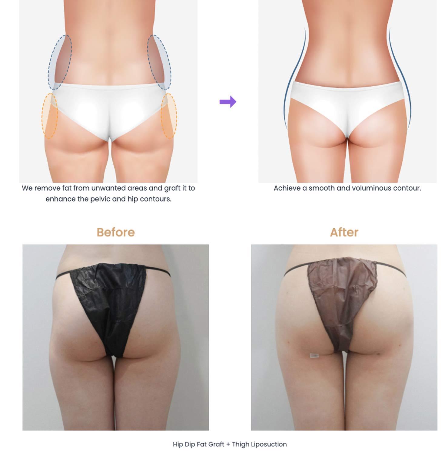 Hip Dip Fat Grafting before and after