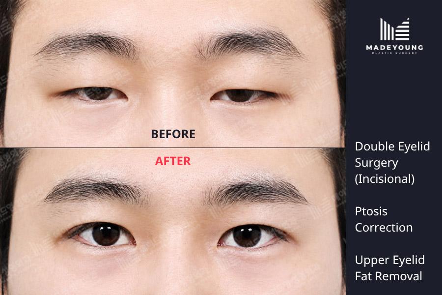 Eyelid surgery incisional ptosis correction upper eyelid fat removal
