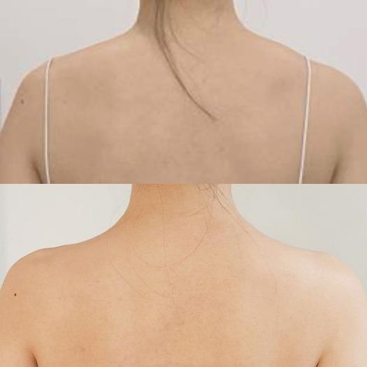 Before and After Fat Dissolving Injection