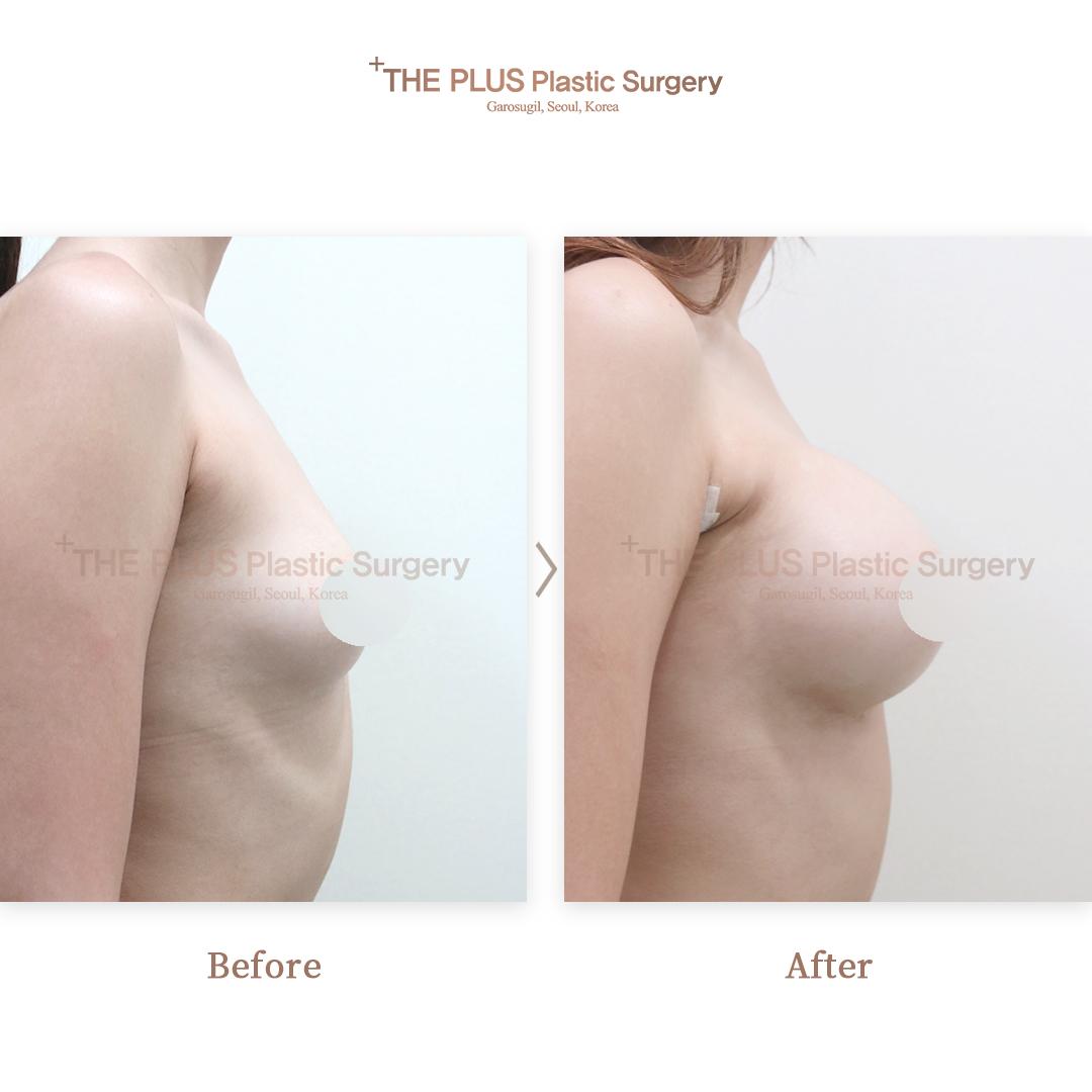 Before and After Breast Implant