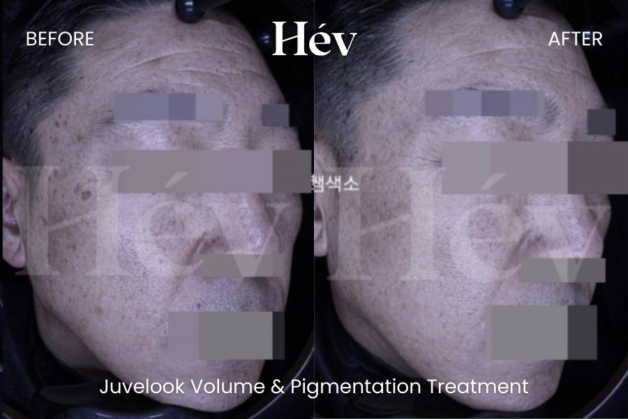 Juvelook Volume Pigmentation Treatment