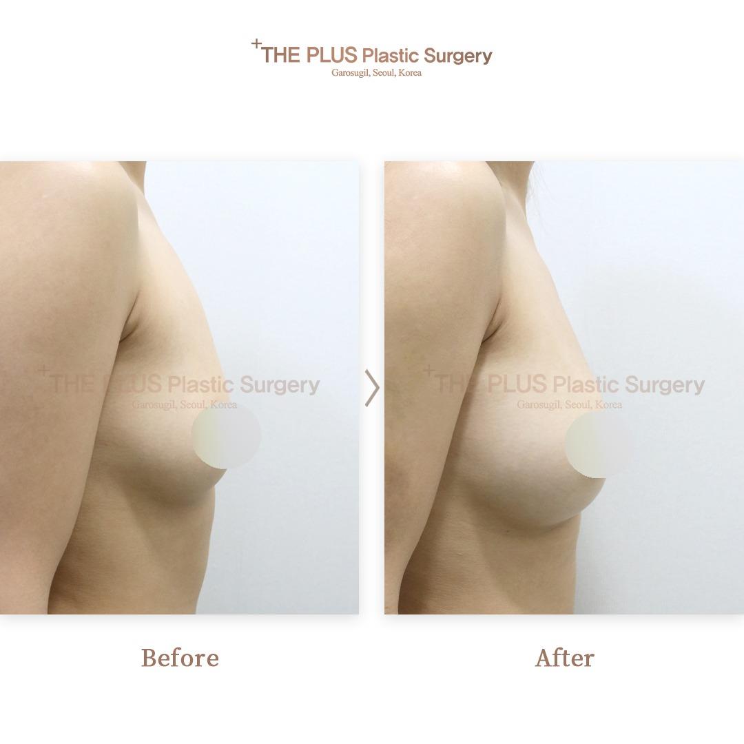 Breast augmentation by autologous fat grafting
