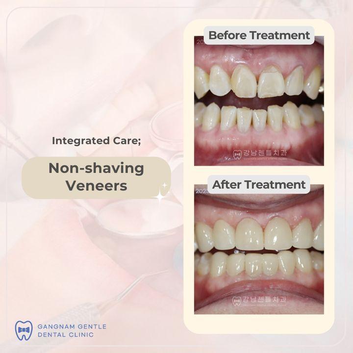 Non-shaving veneers can be a suitable option for individuals who want to enhance the appearance of their teeth but prefer to preserve as much of their natural tooth structure as possible. However, it's important to note that not all cases are suitable for non-shaving veneers. The decision to use traditional veneers or non-shaving veneers depends on factors such as the patient's specific dental needs, the alignment of their teeth, the condition of their enamel, and their desired outcome.  It's recommended to consult with a qualified dentist to determine which type of veneer is most appropriate for your individual case and aesthetic goals.