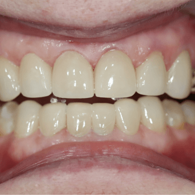 After Veneers