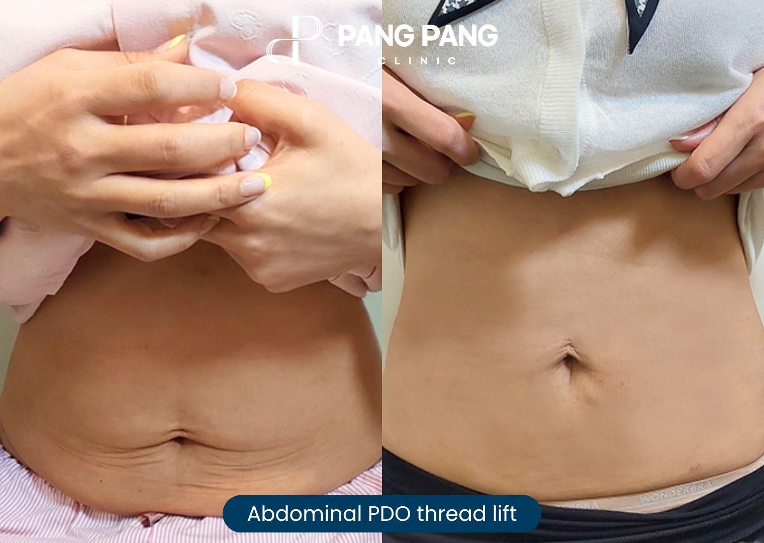 Female abdominal PDO thread lift