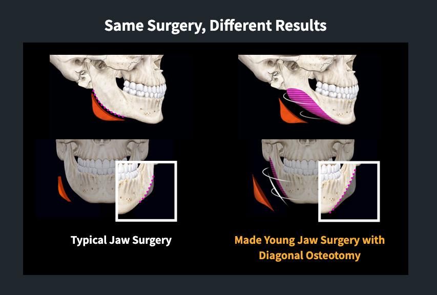 Square Jaw Surgery