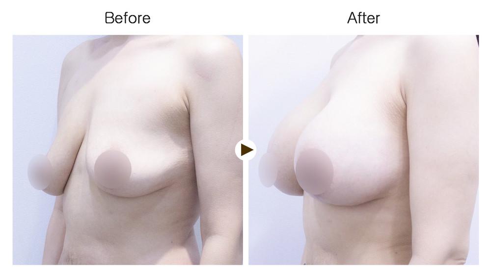 Breast lift with implant