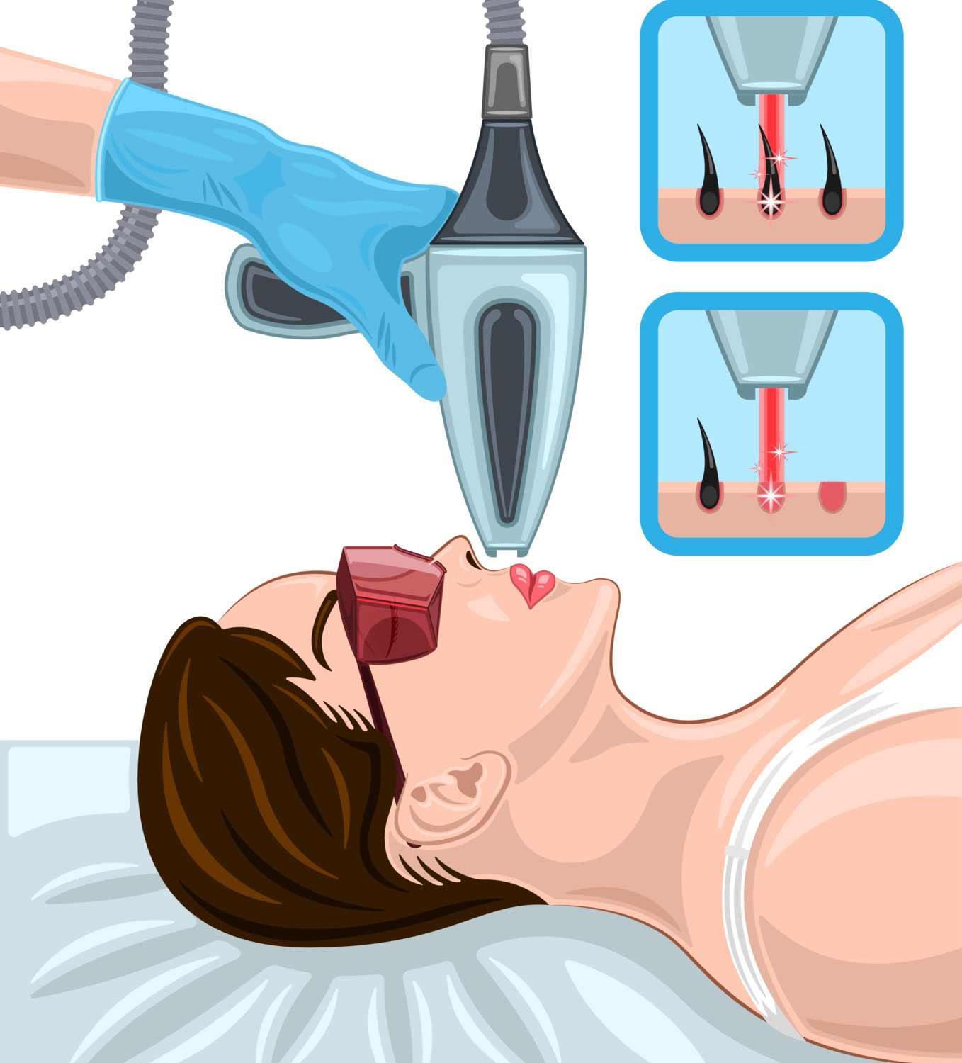 Facial Laser Hair Removal